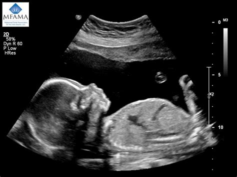 fetal ultrasound dating